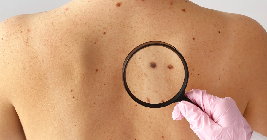 COME-CAPIRE-SE-UN-NEO-E-UN-MELANOMA-HORIZON